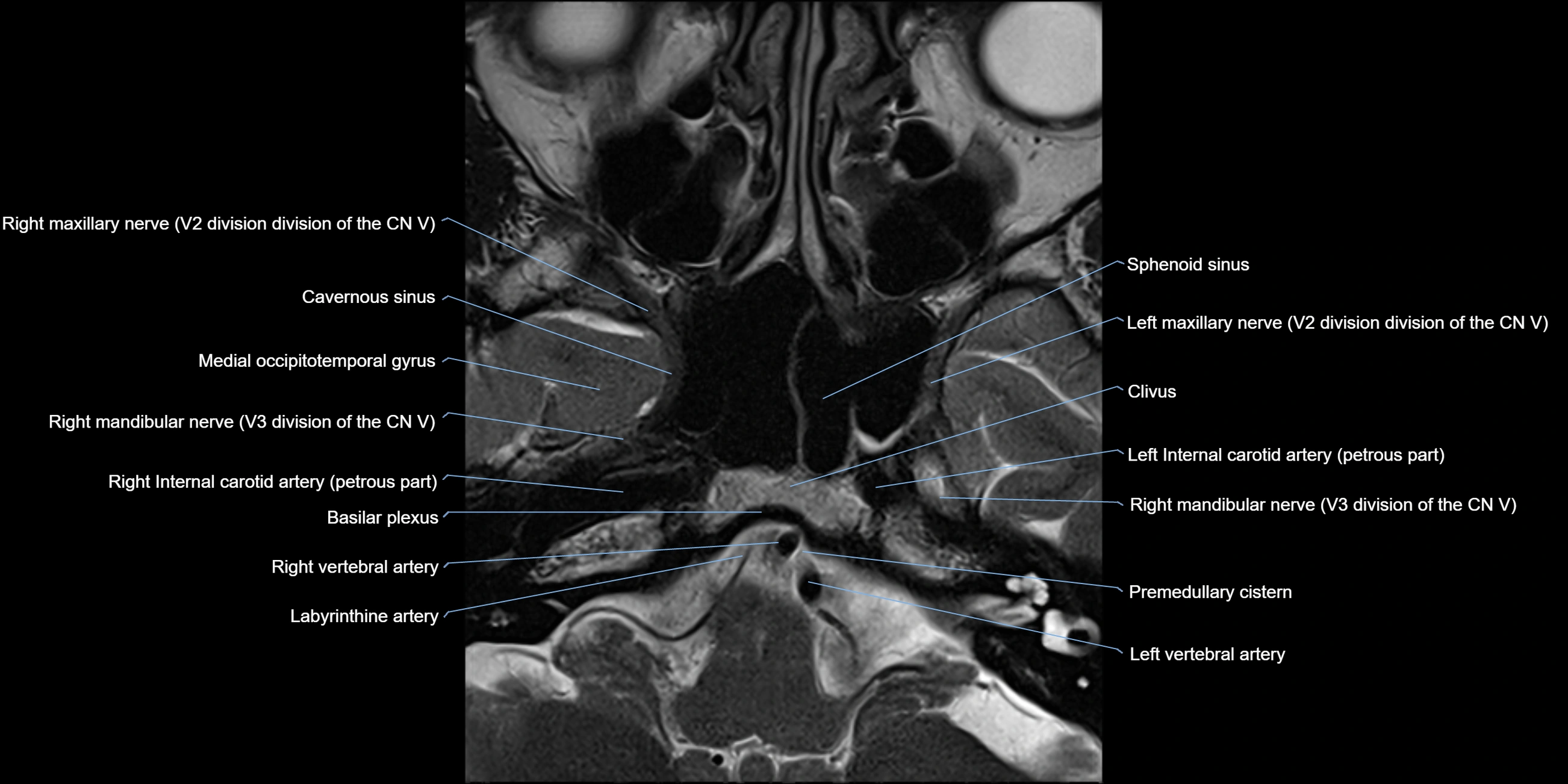 MRI cavernous sinus axial cross sectional 3T anatomy image-img-11001-00003.webp